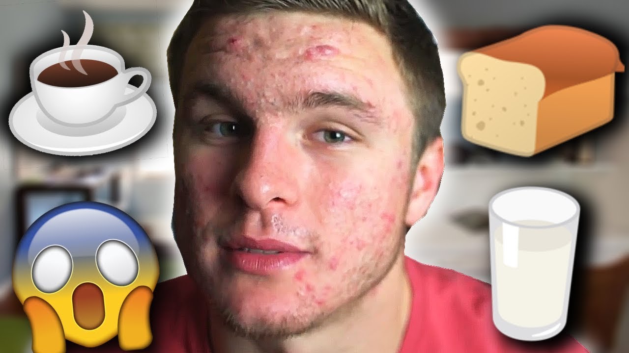 Does Coffee Cause Acne?